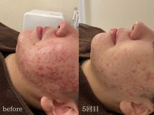 アイル 江坂店(iru)/剥離ありハーブピーリング5回目