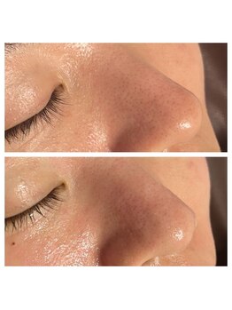 ピュアスキンサロン 恵比寿店(pure skin salon)/韓国肌管理【恵比寿渋谷】