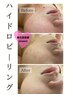 ニキビ/痕/毛穴【肌質改善】ハイドロピーリング◆専用美容液プレゼント♪