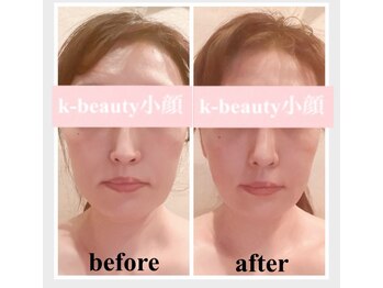 ケービューティー 小顔(K-beauty)/小顔コルギ