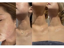 ビーティークリニカル 新宿三丁目(BT clinical)/白玉フェイシャルコース