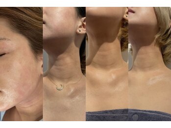 ビーティークリニカル 新宿三丁目(BT clinical)/白玉フェイシャルコース