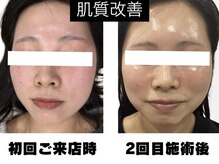 ルミネル 名古屋新栄(Luminelle)/韓国美肌水光ピーリング