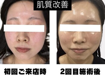 ルミネル 名古屋新栄(Luminelle)/韓国美肌水光ピーリング