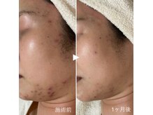 シェノンの雰囲気(たった1ヶ月でしつこいニキビ劇的改善!)