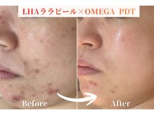 リラ(Lilas)の雰囲気（ニキビ/毛穴にはララピール×OMEGA PDT！最新LED美容で肌質改善）