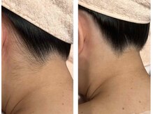 アドビューティ(Add Beauty)/花嫁様プラン／ブライダルエステ