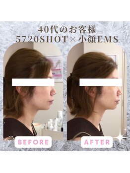 ラ セラフィータ 中目黒/【上級小顔】EMS美容液導入付き