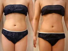 エイプリル/【痩身】比較写真