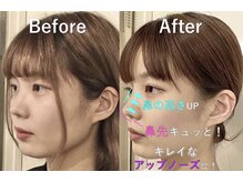 ラプリ 横浜店(Raplit)/隆鼻＋輪郭矯正40分
