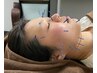 【ベース美容鍼】　美容鍼　お顔のみ　３０分　３０００円