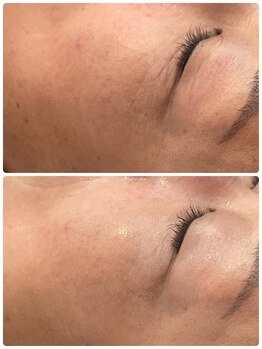 トリアングル(TLIENGLE)/ハーブピーリングbefore after