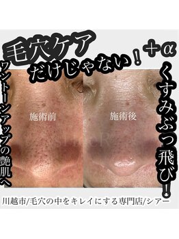 シアー(sHeeR)/毛穴ケア