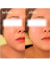 アルバ スキンガーデン(ALBAスキンガーデン)/before・after〈30代〉