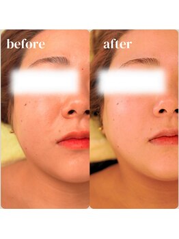 アルバ スキンガーデン(ALBAスキンガーデン)/before・after〈30代〉