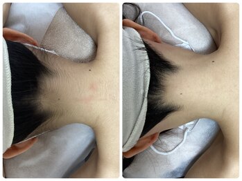 ルルトウキョウ 池袋店(LULU.tokyo)/うなじ脱毛