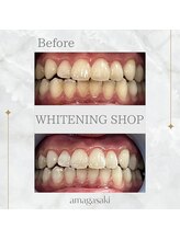 ホワイトニングショップ 尼崎店/セルフホワイトニング1回の効果