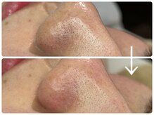 ニコ(Nico)/毛穴エクストラクション