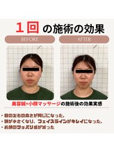 クローバー鍼灸整骨院/小顔矯正マッサージ+美容鍼　