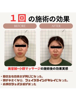 クローバー鍼灸整骨院/小顔矯正マッサージ+美容鍼　