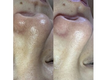 ルピナス 立川店/ハイドロ毛穴洗浄