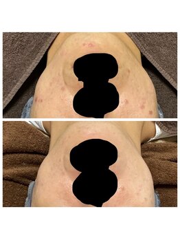 リラーナ(Re rana)/メンズニキビケア♪