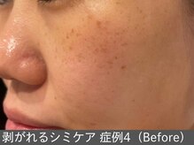 オアシスラグーン(OASIS LAGOON)/シミケア（症例4 before）30代