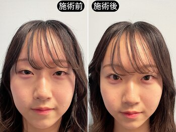 アオヤマ サロン ワイゼット(AOYAMA SALON YZ)/写真映え小顔へ