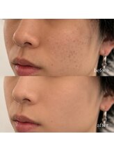 アーネスト 大阪心斎橋店(EARNEST)/20代前半男性【月額肌質改善C】