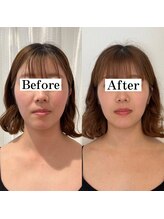 ドクターボディ 浜松店(Dr.Body)/【ほうれい線/頬骨/小鼻縮小】