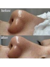 ライカブルー(RaicA BluE)/施術写真