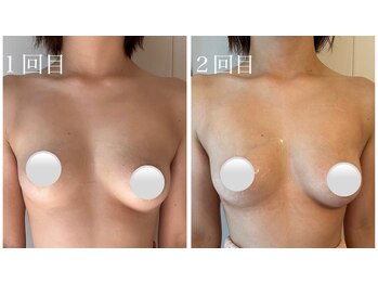 美バストアルファ(美bust α)/【光豊胸】症例