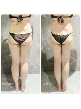 インディバ 六本木/【腹腰集中痩身】before→after