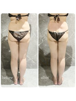 インディバ 六本木/【腹腰集中痩身】before→after