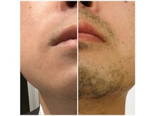 人気のヒゲ脱毛。お肌の負担も減らせます。