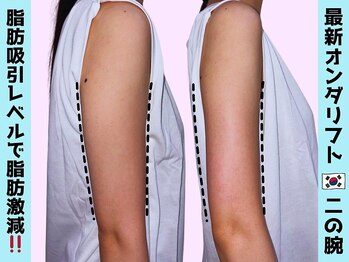 オンダリフト東京　大阪梅田店【韓国肌管理】オンダリフト/ララ ピール/小顔矯正/痩身/オンダリフト/梅田/ララピール