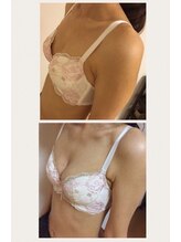美人バスト 本厚木店/バストアップ◇症例◇