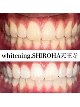 シロハ(SHIROHA)/セルフホワイトニング/天王寺