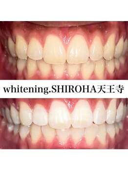 シロハ(SHIROHA)/セルフホワイトニング/天王寺