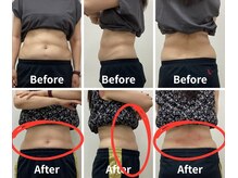 Noa接骨院 はりきゅう院/脂肪冷却　B/A写真