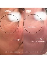 エン(EN)/お顔のしわやたるみから解放体験