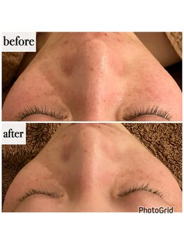 メナードフェイシャルサロン 岐阜茜部/ホワイトニングパック