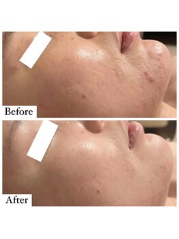 ベル 恵比寿(Belle)/REVI陶肌ハーブピーリング