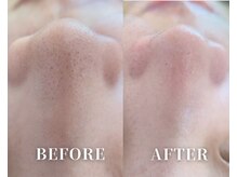 リブレ(LIBRE)/韓国式3D毛穴洗浄