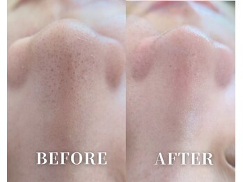 リブレ(LIBRE)/韓国式3D毛穴洗浄