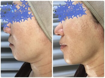 ミロク(369)/Before&After 小顔プラズマ