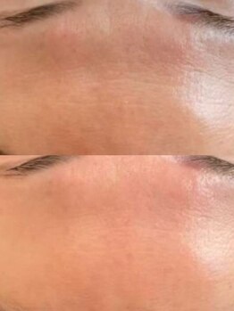 ラエッセ 恵比寿(LAESSE)/毛穴・美白専門店 LAESSE 恵比寿