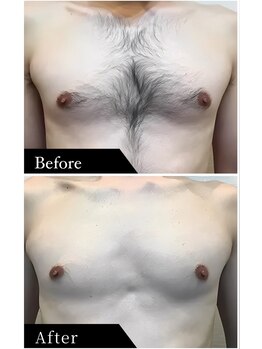 ビビ(BiBi)/before after