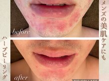 ラナ(LaNa)/男性のにきびケア