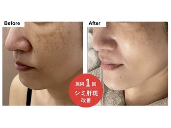 エン(O'en)/エクソソーム＋幹細胞導入♪